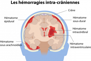 5 types d'hématomes intracrâniens