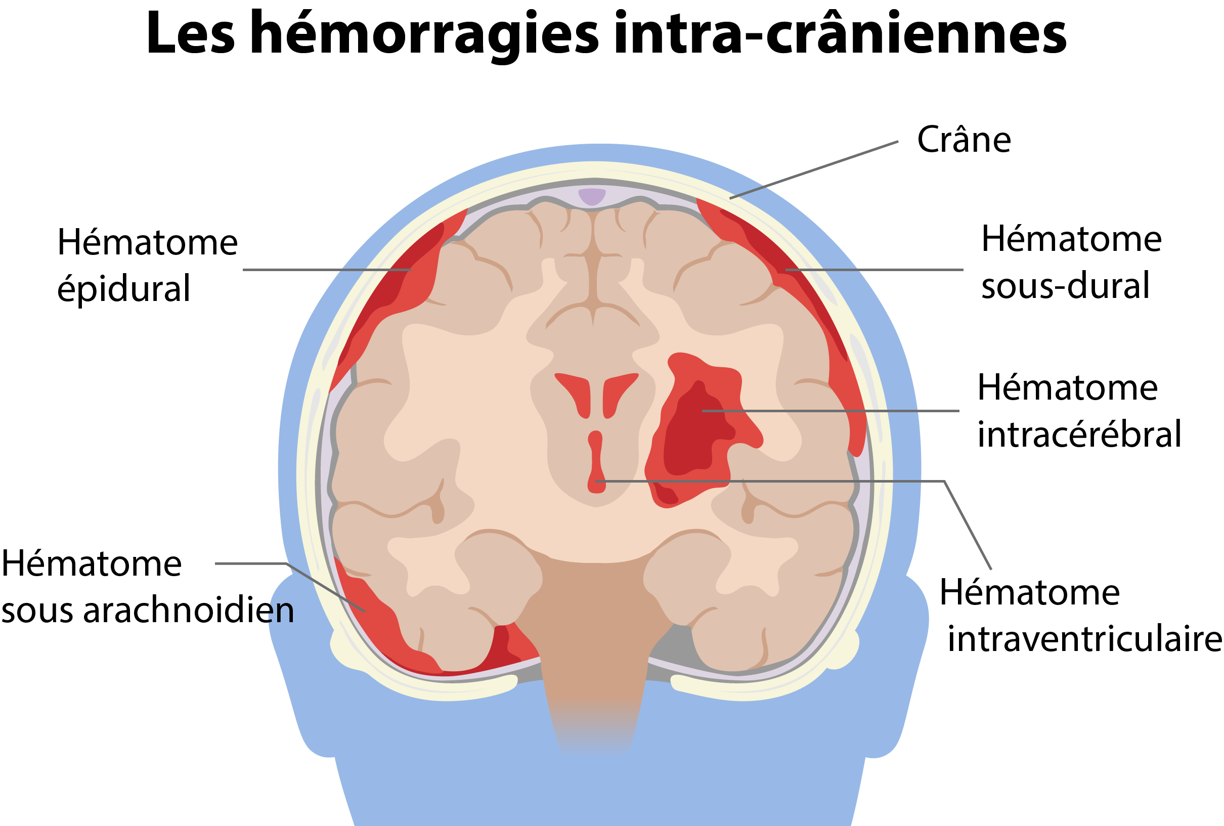 5 types d'hématomes intracrâniens