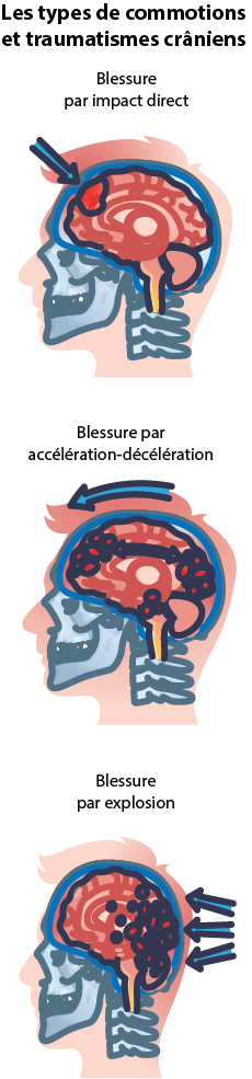 Types de commotions cérébrales et de traumatismes crâniens ou de blessures à partir d’un diagramme de vue médicale